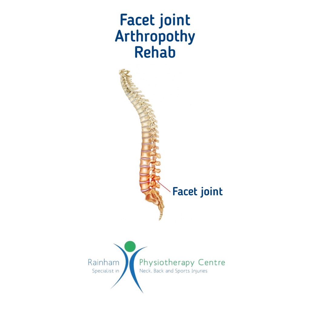 Facet Joint Arthropathy Rehabilitation Rainham Physio
