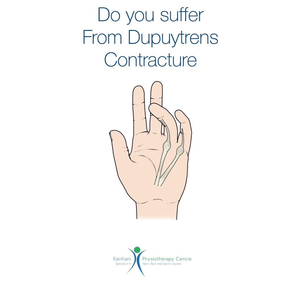 Do you suffer from Dupuytren’s Contracture? Rainham Physio