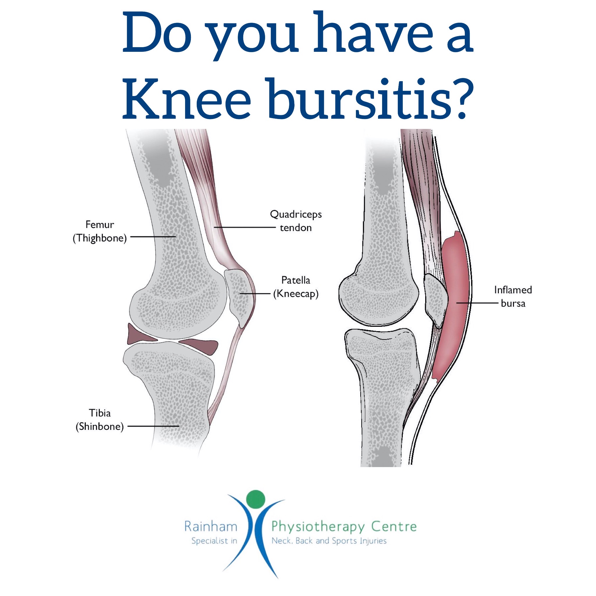 Do you have a knee bursitis?